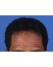 After Hair Transplant &nbsp;Front